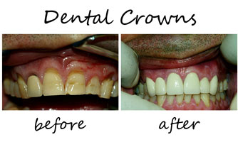Dental Crown Restoration Chandler AZ