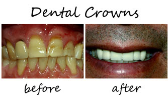 Dental Crown Process Chandler AZ