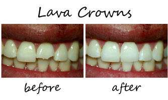 Dental Crown Longevity Chandler AZ