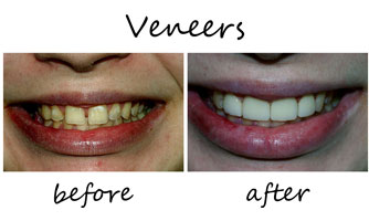 What Are Dental Veneers Chandler AZ