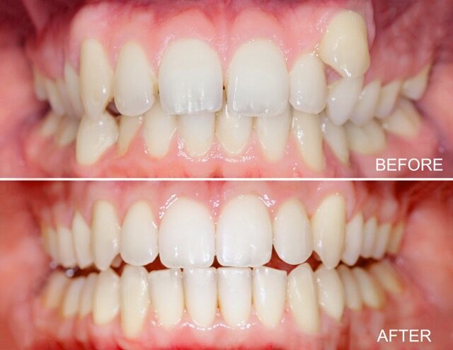 Invisalign corrects crooked teeth gaps and crowding