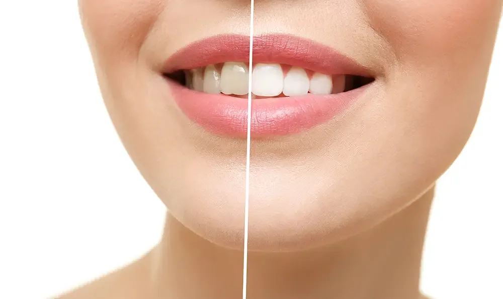 At-Home Teeth Whitening Kit Chandler AZ