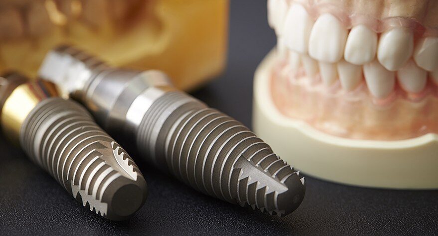 Dental Implant Process Chandler AZ