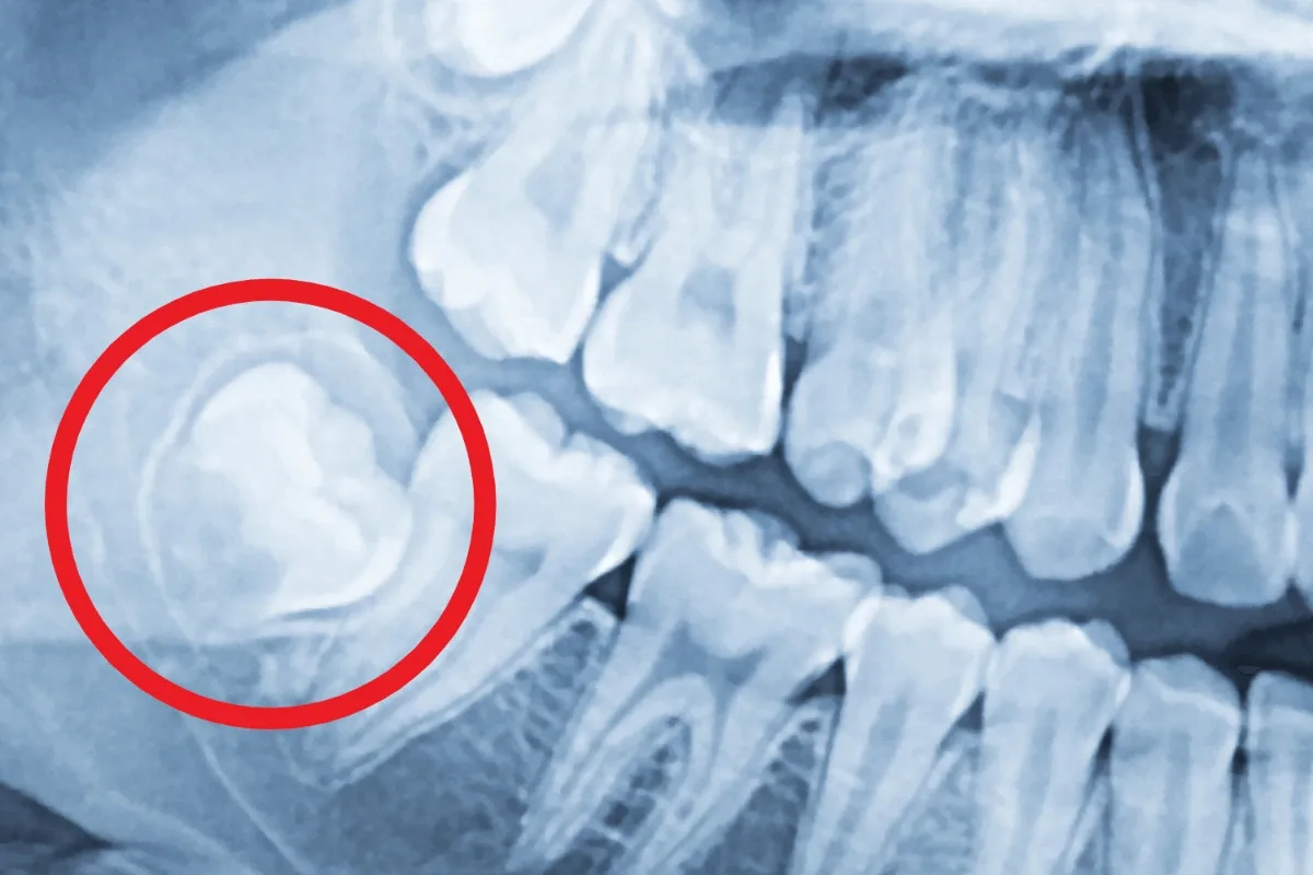Why Remove Wisdom Teeth Chandler AZ